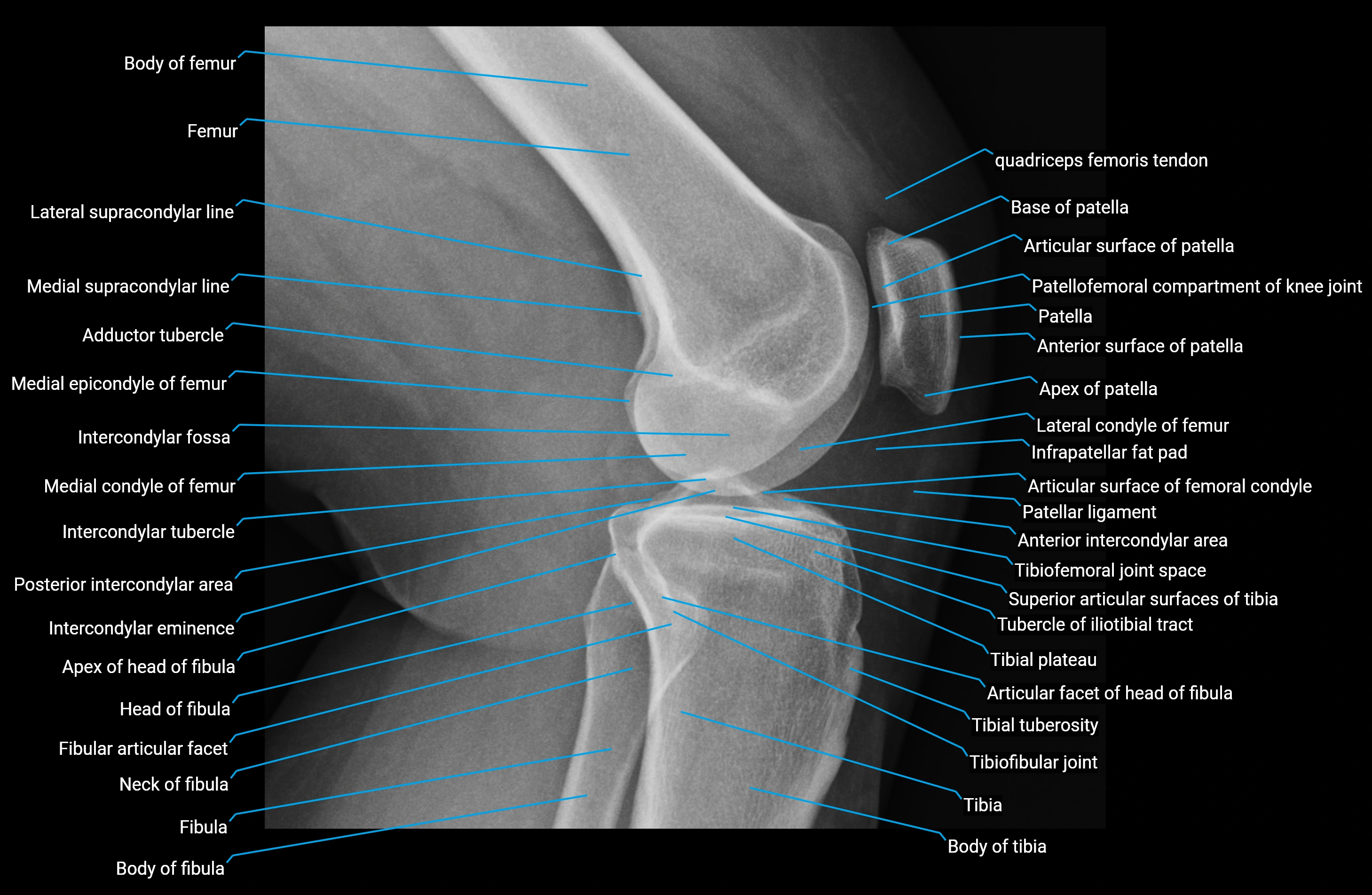 X Ray knee lateral anatomy labelled.webp